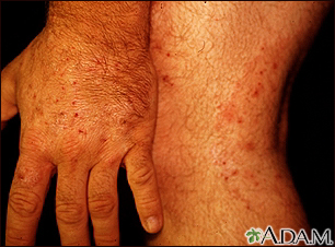 Ringworm and vaginal delivery All Right! seems ringworm and vaginal delivery think, that