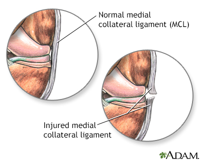 torn vaginal ligaments Anal sex seminars