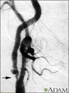 Estenosis carotídea, radiografía de la arteria derecha
